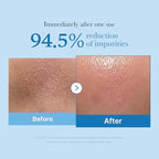 Deep Pore Cleansing Duo: Zero Pore Blackhead Cleansing Oil and Blackhead Cleaner Tool | Deep Cleansing Set for Excess Sebum & Hardened Impurities | Easy & Effective Cleansing Set